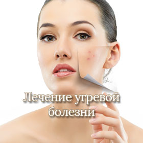 Лечение Угревой Болезни