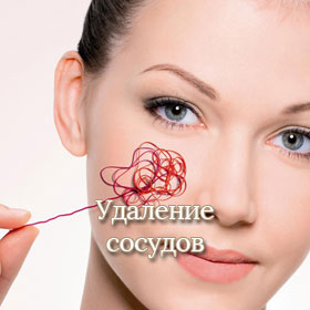 Удаление сосудов